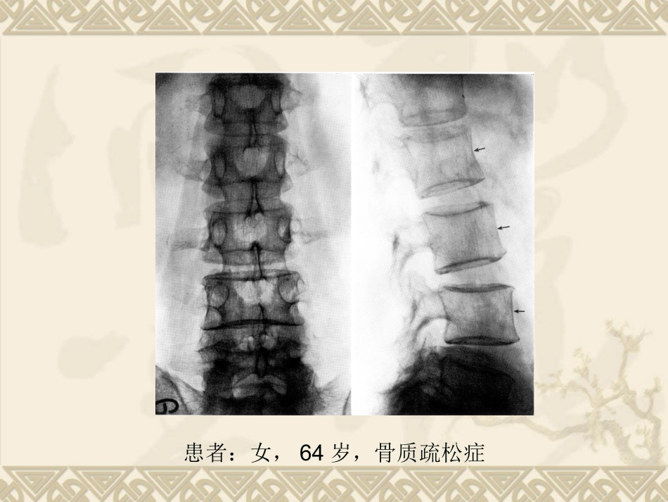 骨质疏松症分析_第3页
