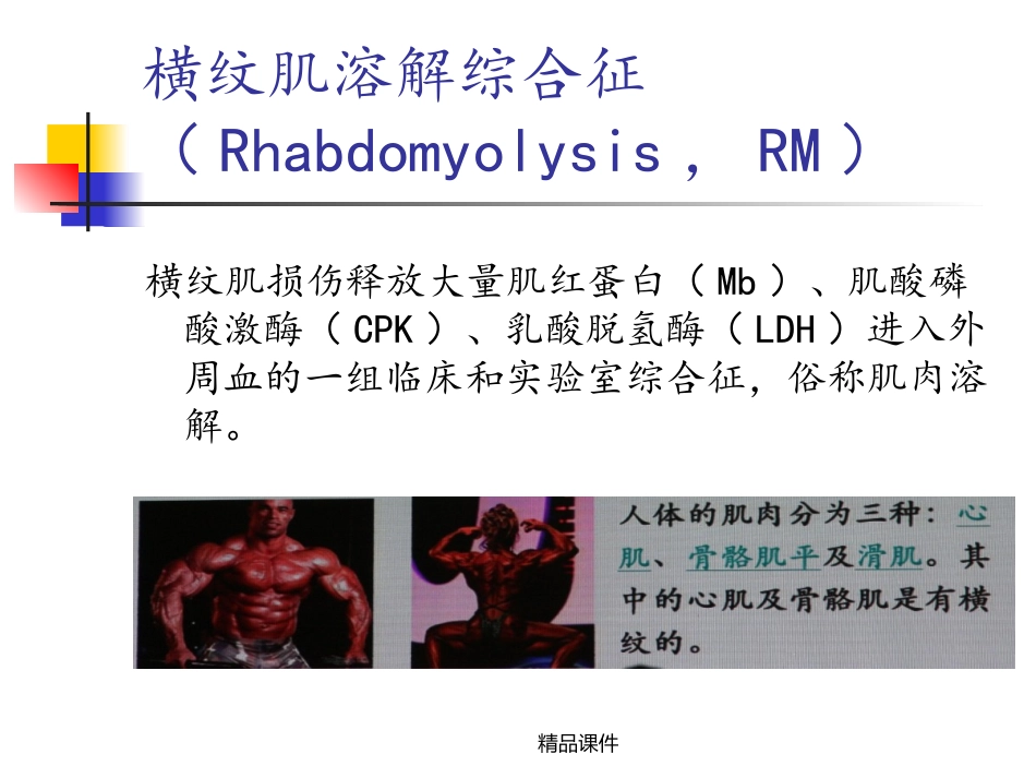 横纹肌溶解综合征_第2页