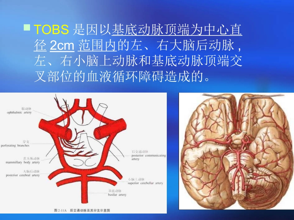 基底动脉尖综合征_第3页