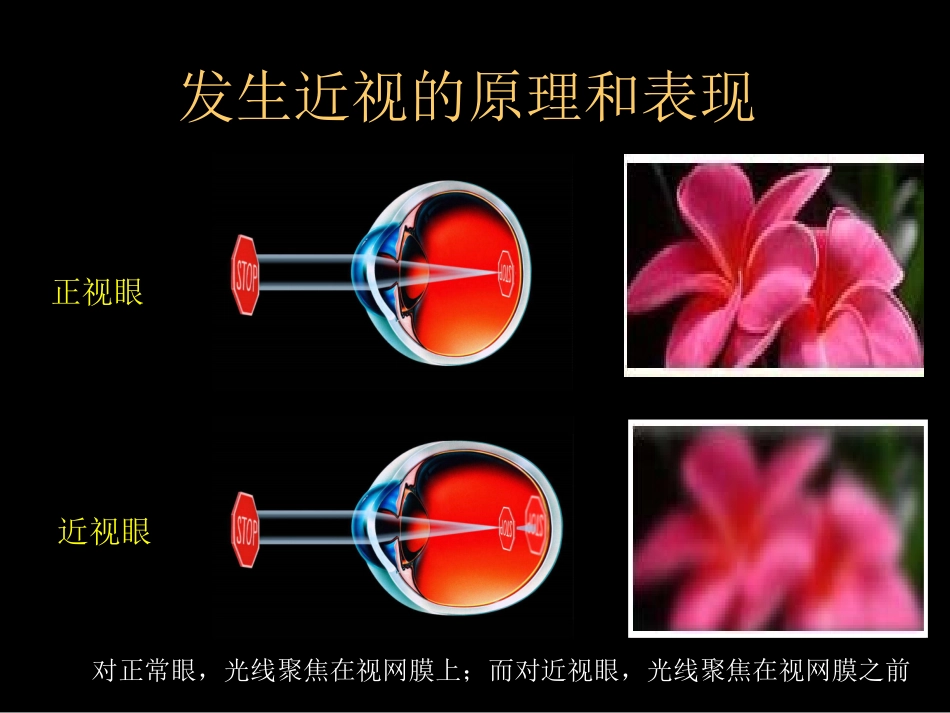 激光近视手术课件_第3页