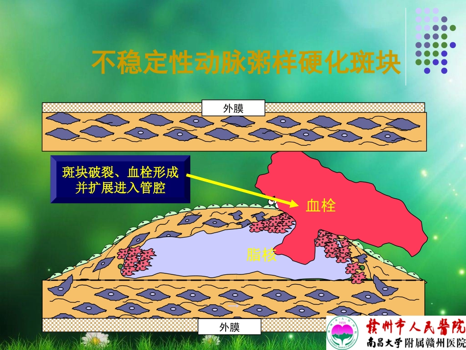 急性心肌梗死护理查房_第3页