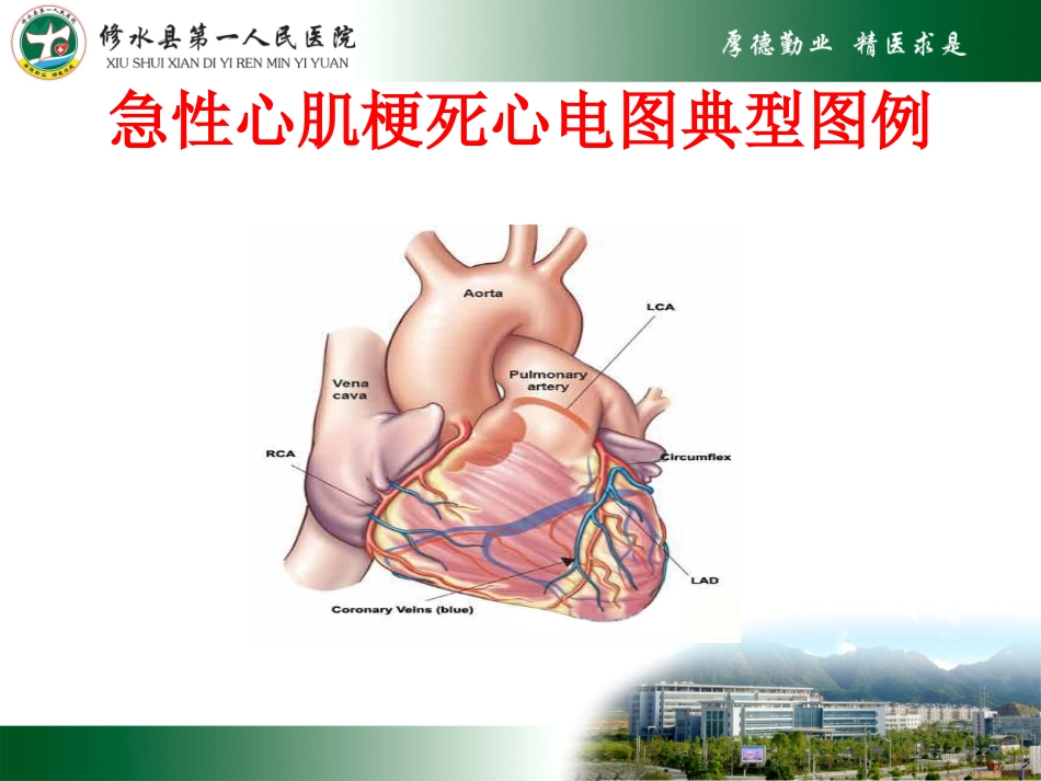 急性心肌梗死及常见心电图识别_第2页