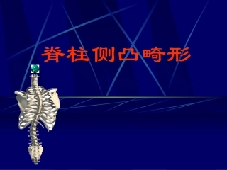 脊柱侧凸畸形