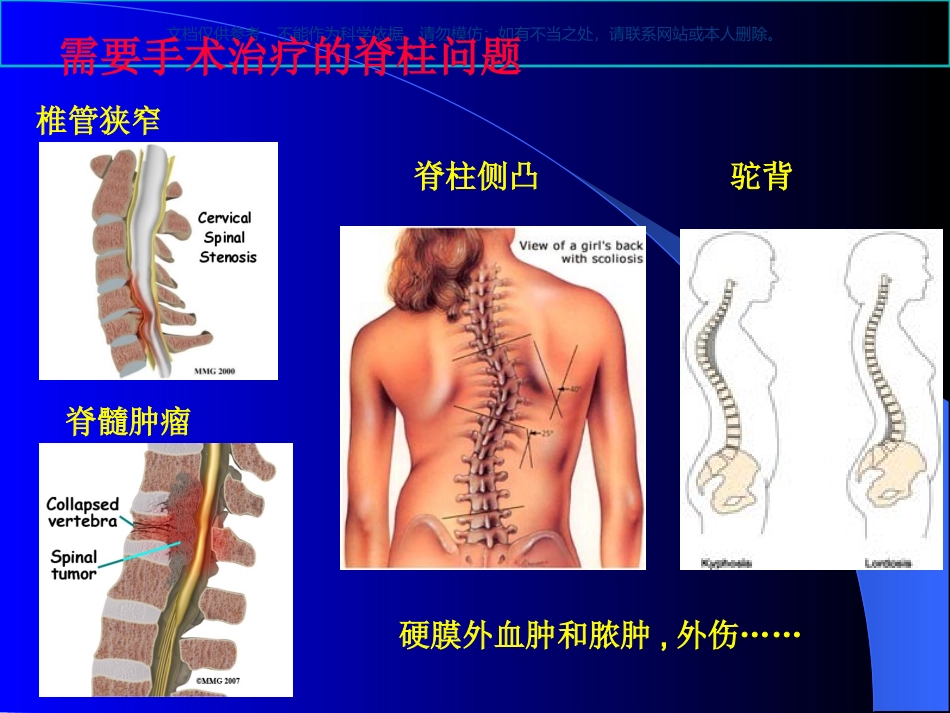 脊柱手术的麻醉课件_第2页