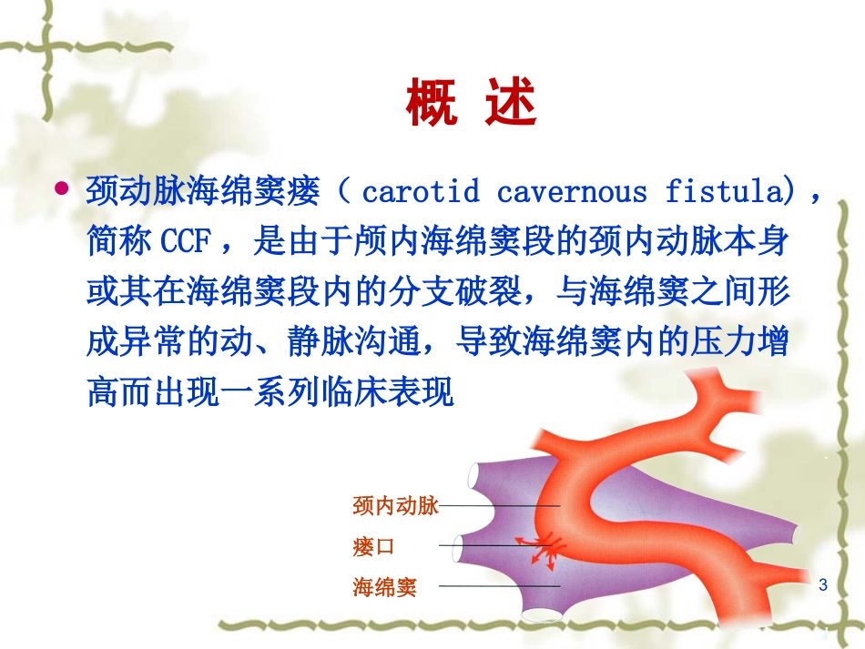 颈内动脉海绵窦瘘的治疗和护理课件_第3页