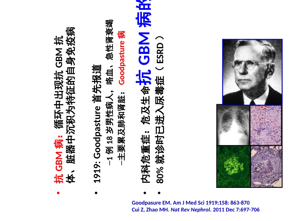 抗肾小球基底膜GBM病_第2页