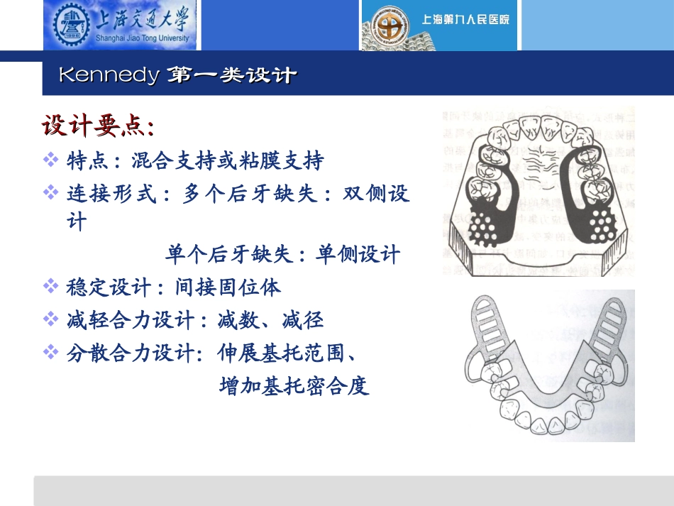可摘局部义齿的分类设计讲义_第2页