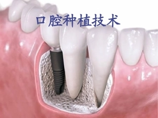 口腔种植义齿技术