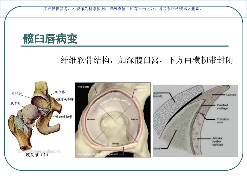 髋关节撞击综合征课件_第3页