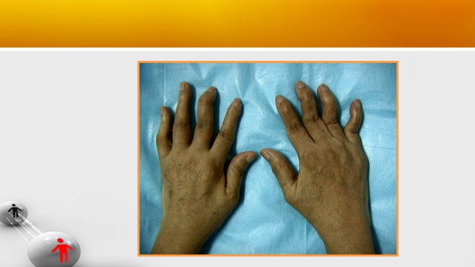 类风湿关节炎中西医结合_第3页