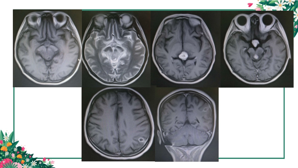颅内生殖细胞瘤_第3页