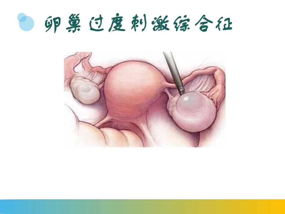 卵巢过度刺激综合征_第2页