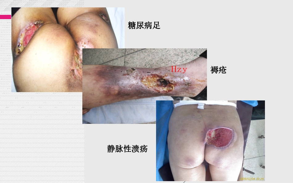 慢性难愈合创面最近进展结合治疗指南_第2页