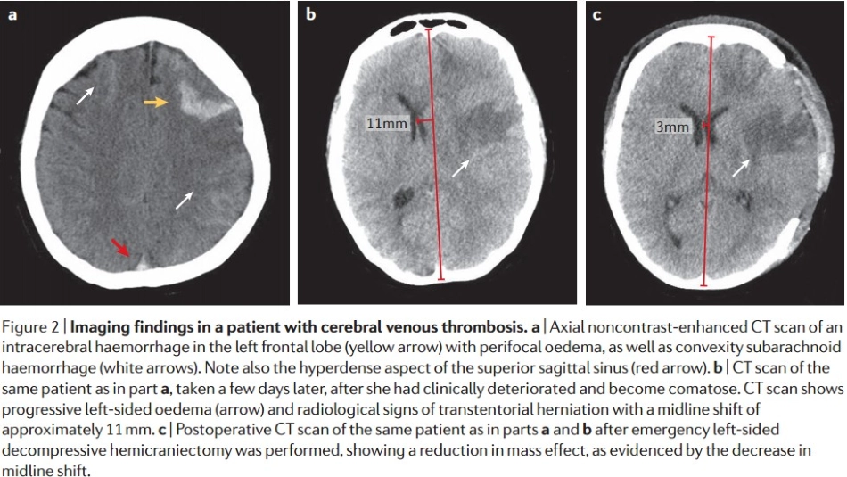 脑静脉梗死的鉴别_第2页