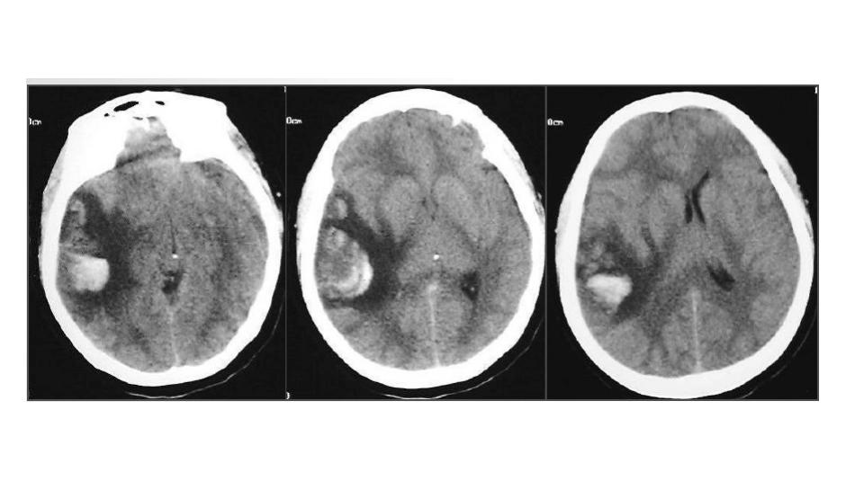 脑静脉梗死的鉴别_第3页