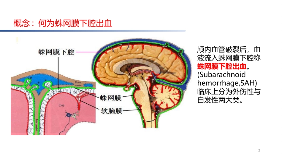脑卒中规范化培训课件蛛网膜下腔出血诊治规范_第2页
