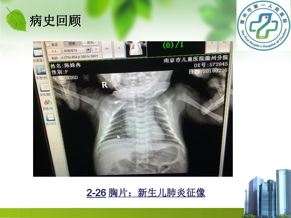 皮罗氏序列征修改_第3页