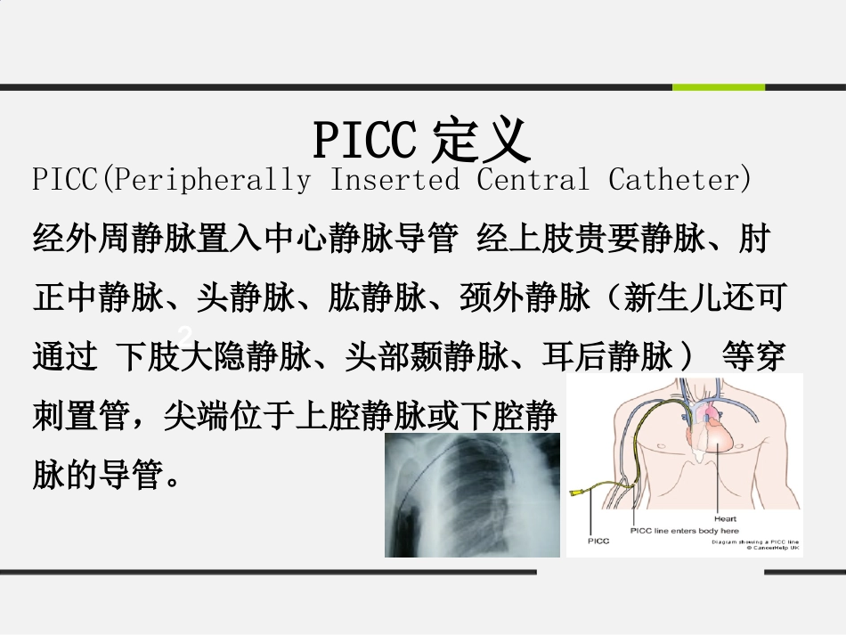 腔内心电图PICC尖端定位技术_第3页