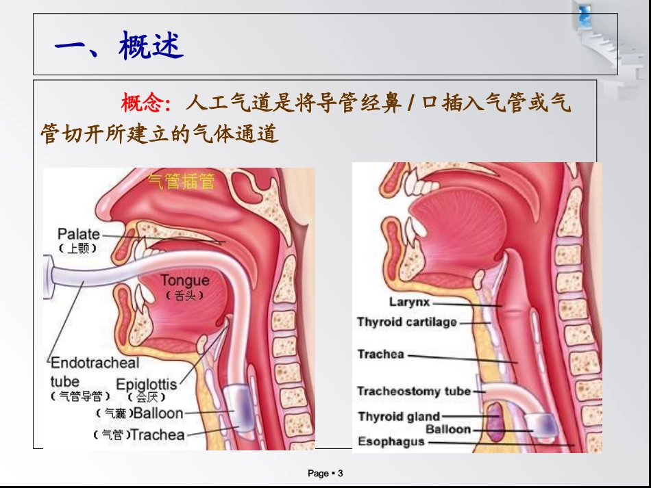 人工气道管理新进展_第3页