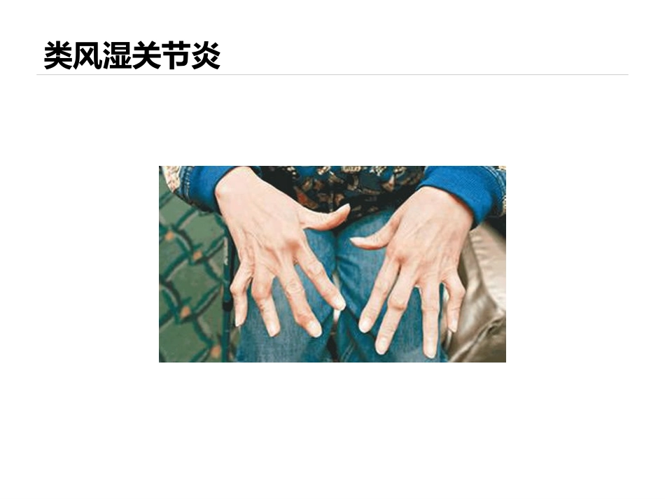 妊娠和风湿性疾病_第2页