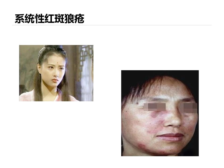 妊娠和风湿性疾病_第3页
