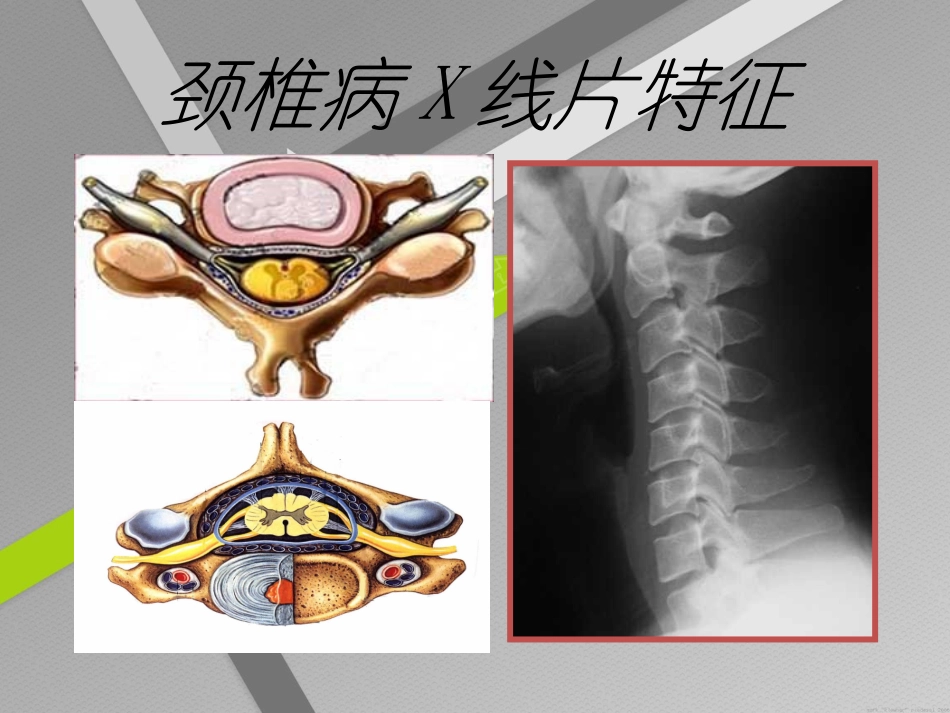 神经根性颈椎病_第3页