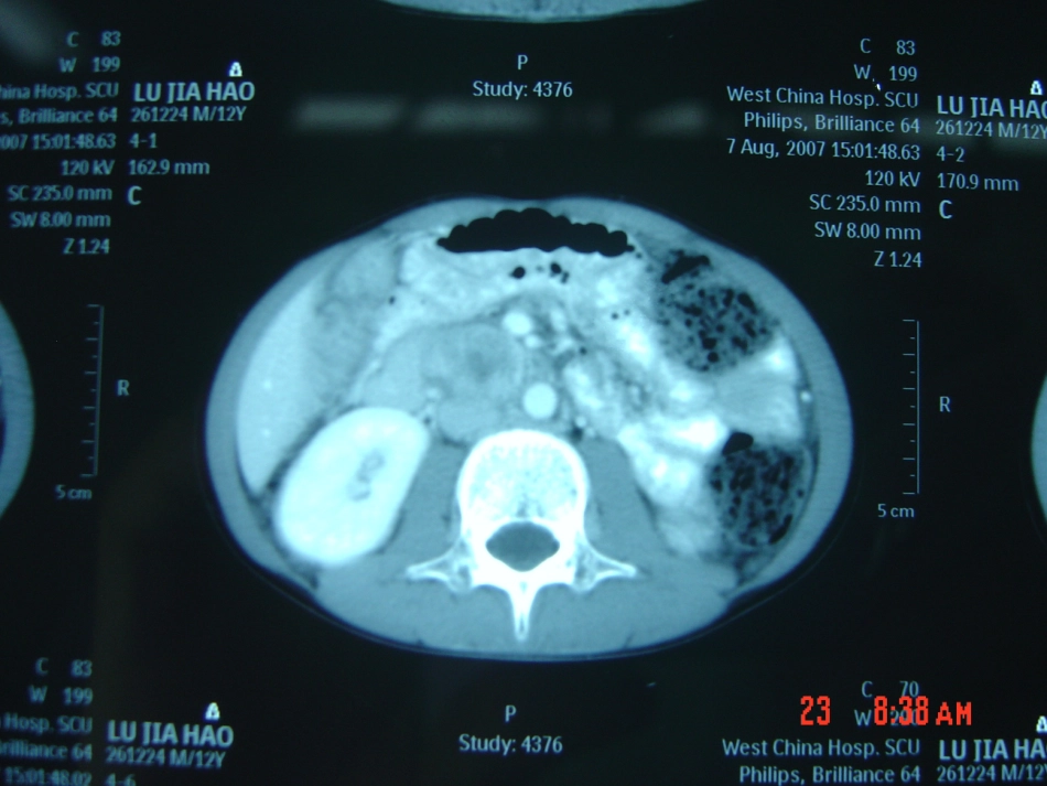 嗜铬细胞瘤麻醉讲义_第3页