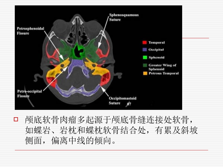 随访病例颅底软骨肉瘤_第3页