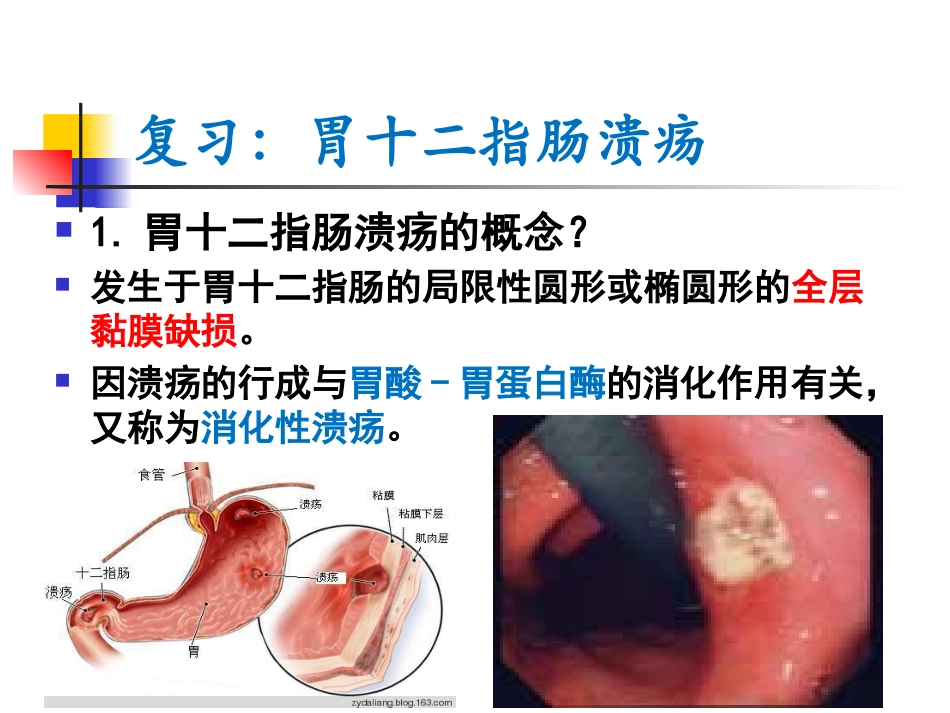 胃十二指肠溃疡外科治疗病人的护理_第2页
