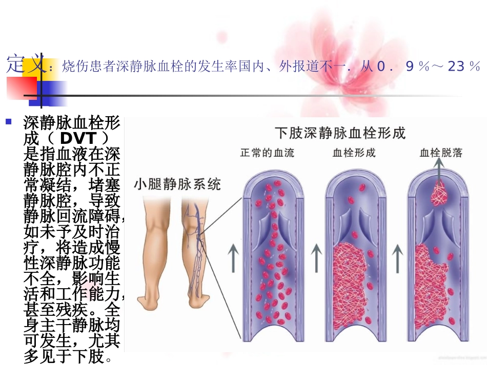 下肢深静脉血栓形成_第3页