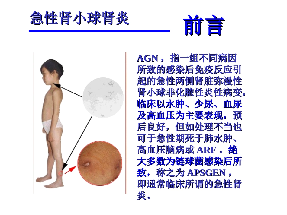 小儿急性肾小球肾炎_第3页
