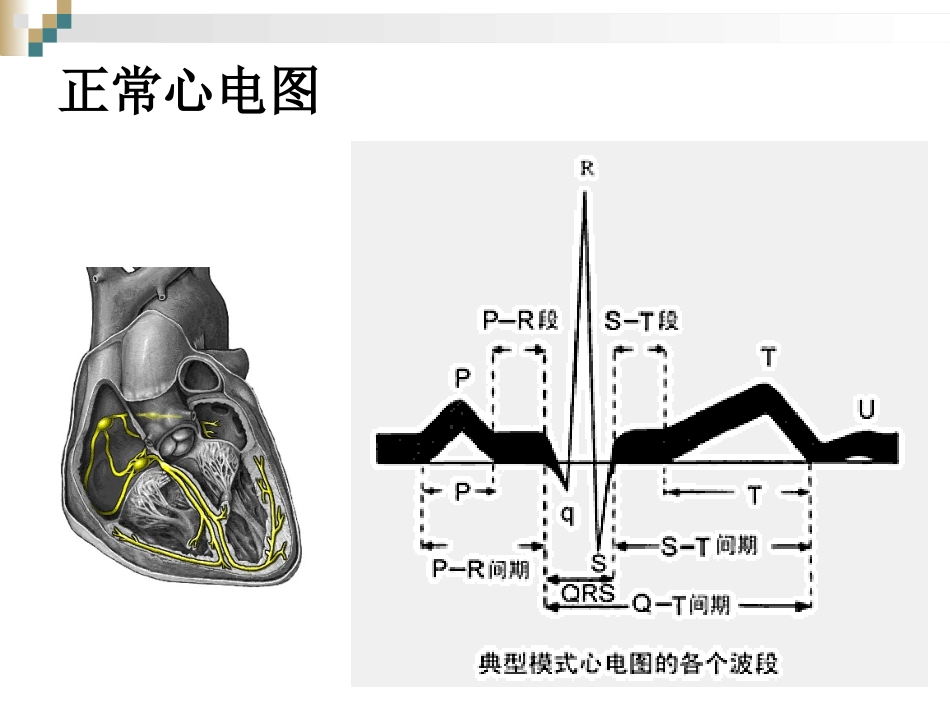 严重心律失常的急救和护理_第3页