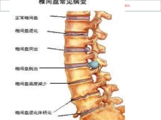 腰椎间盘突出CT和MRI磁共振课件