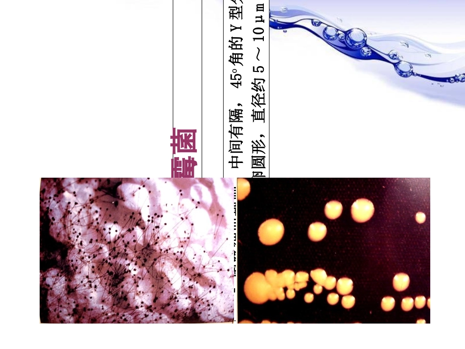 医学变应性支气管肺曲霉菌病ABPA培训课件_第2页