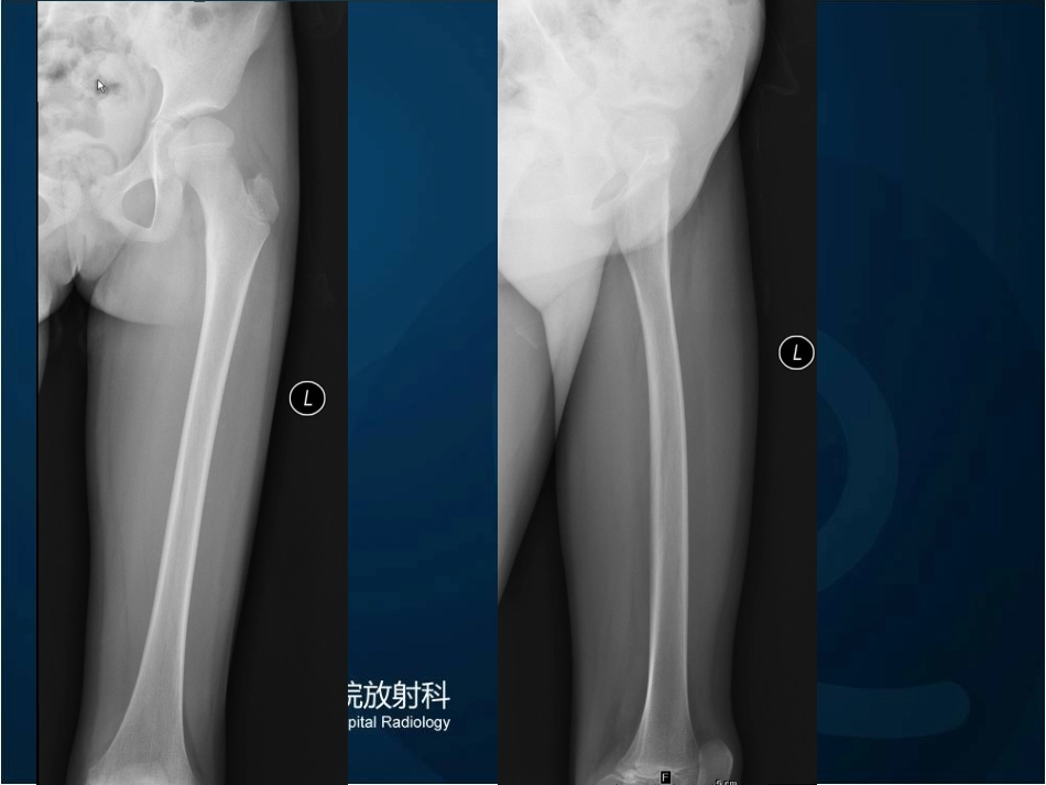 医学骨样骨瘤四例读片培训课件_第3页