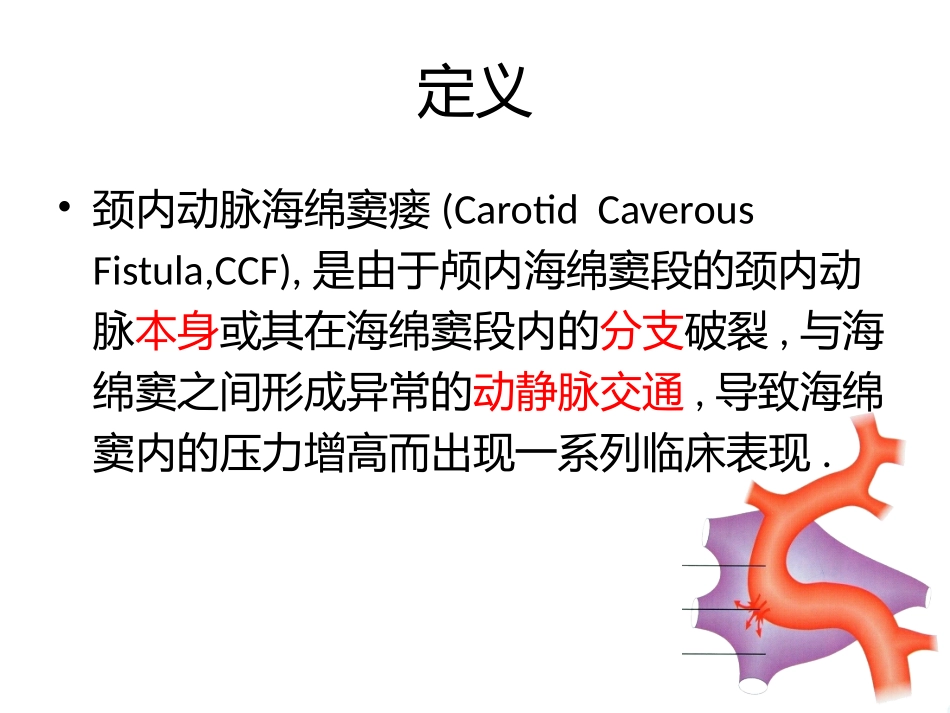 医学颈内动脉海绵窦瘘讲课课件_第2页