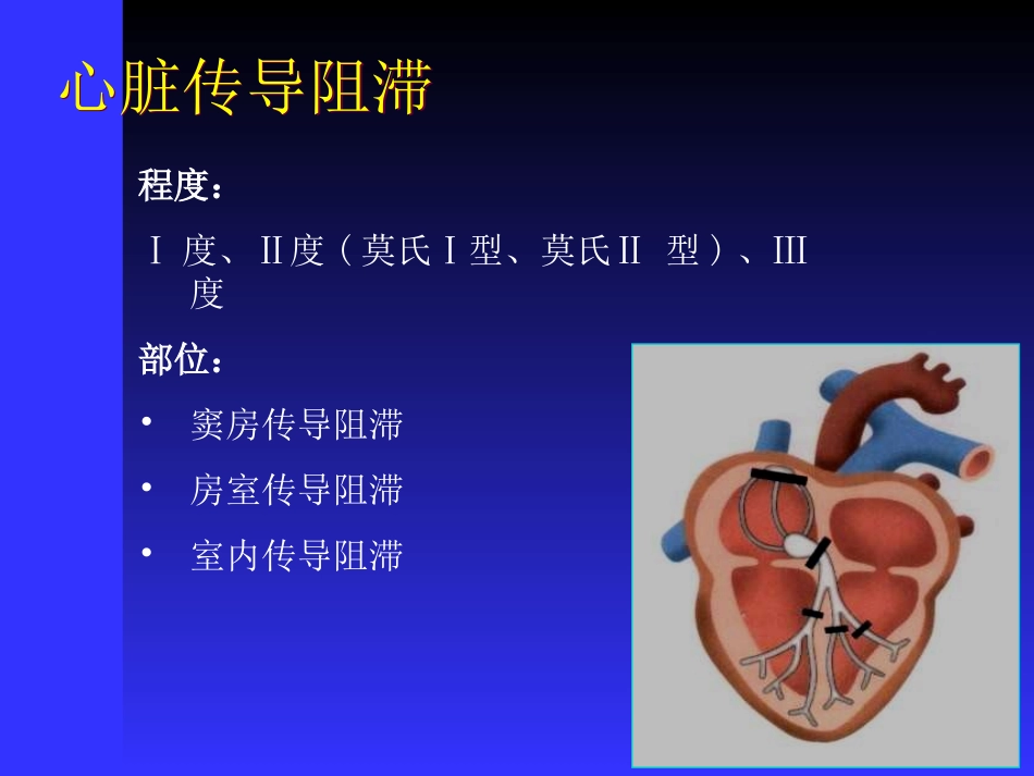 医学课件传导阻滞心电图讲稿_第2页