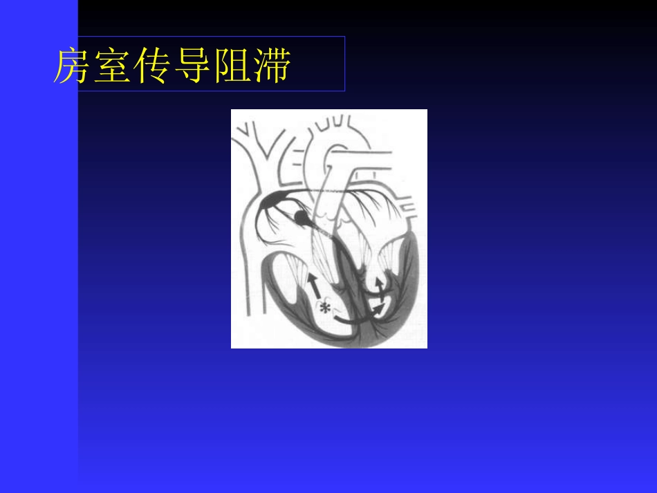 医学课件传导阻滞心电图讲稿_第3页