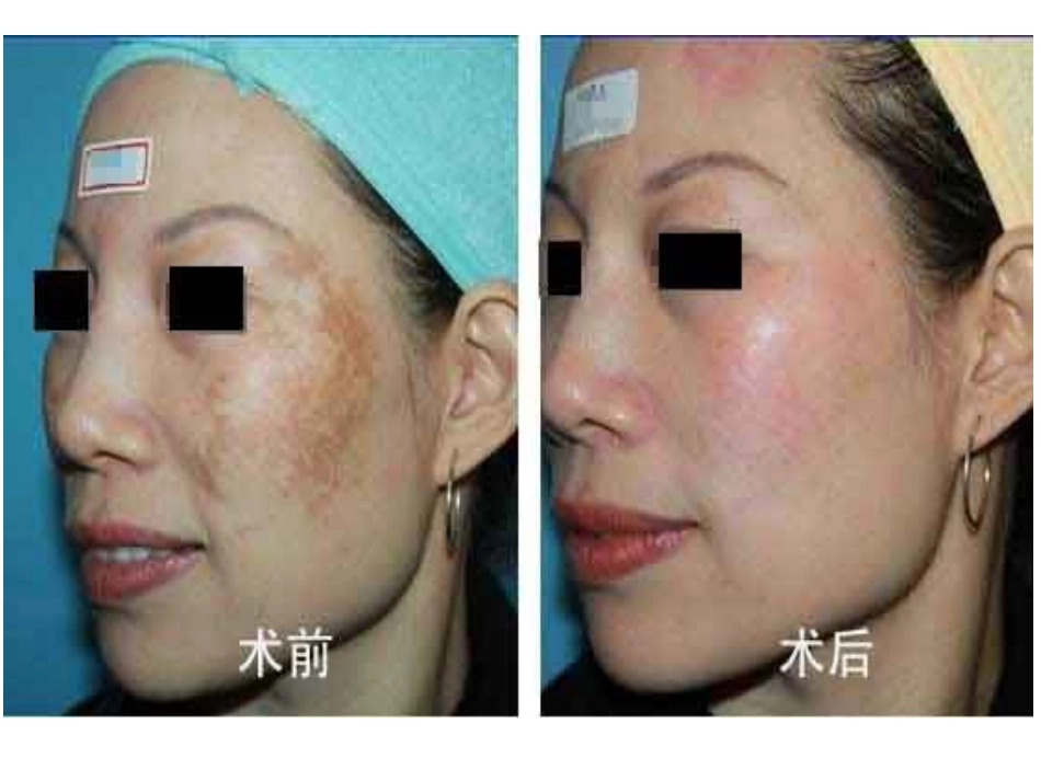 医学课件各种皮肤疾病总结_第3页