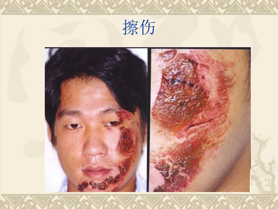 医学课件口腔颌面部外伤病人的护理_第3页