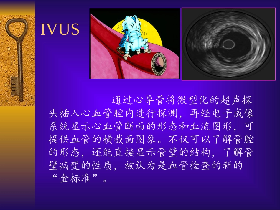 医学课件血管内超声IVUS的相关资料_第2页