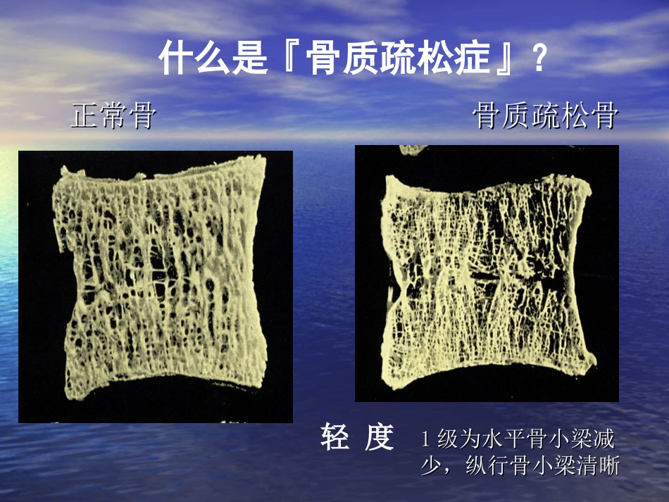 医学糖尿病性骨质疏松症专题课件_第2页