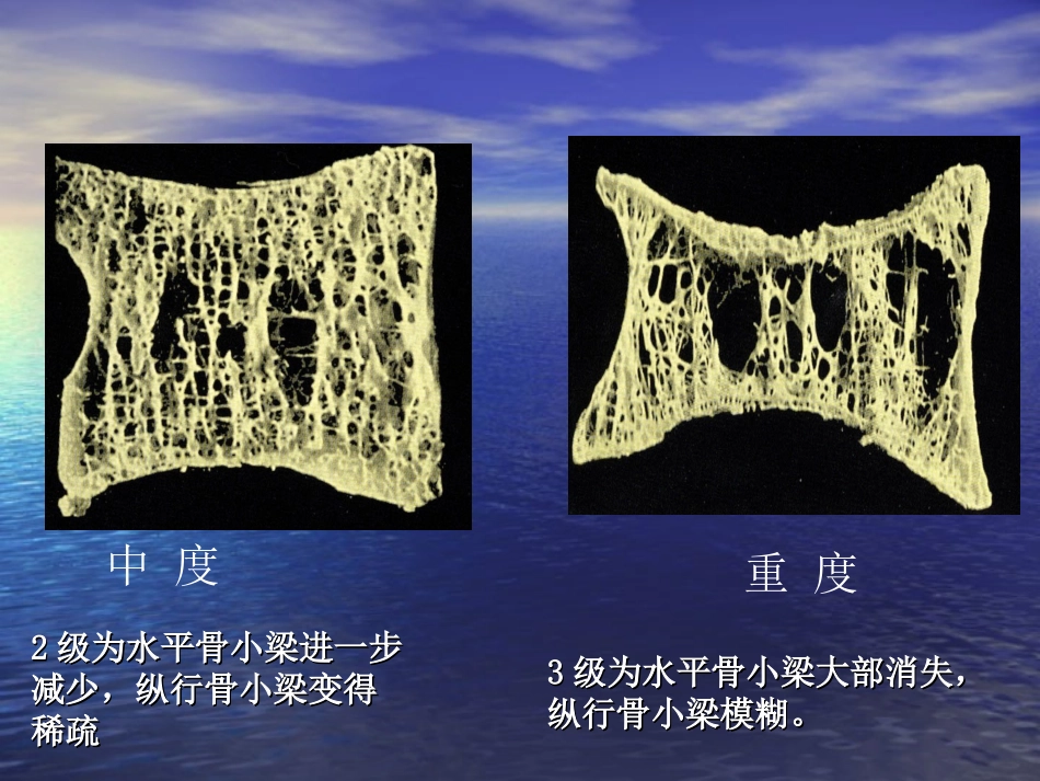 医学糖尿病性骨质疏松症专题课件_第3页
