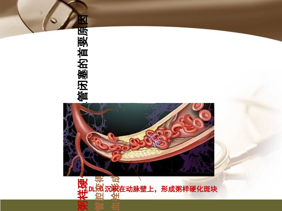 医学心肌梗死健康宣传课件_第3页