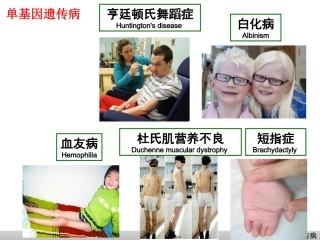 医学遗传学第七章多基因遗传病