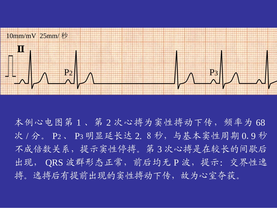 逸搏和逸搏心律培训课件_第3页