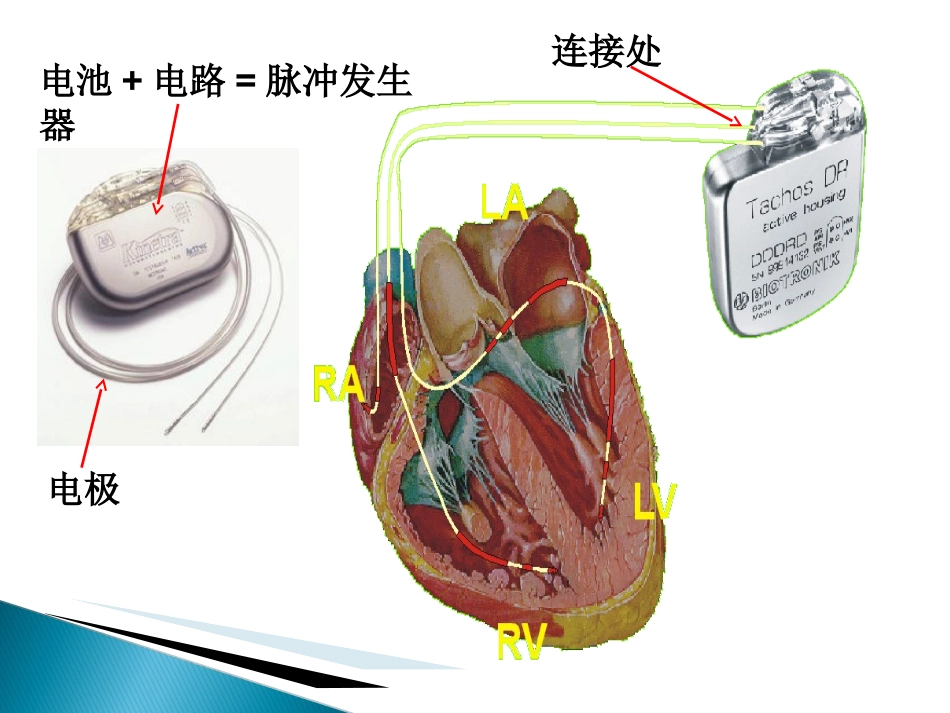 永久性人工起搏器植入术后囊袋并发症的预防和医疗护理讲义_第2页