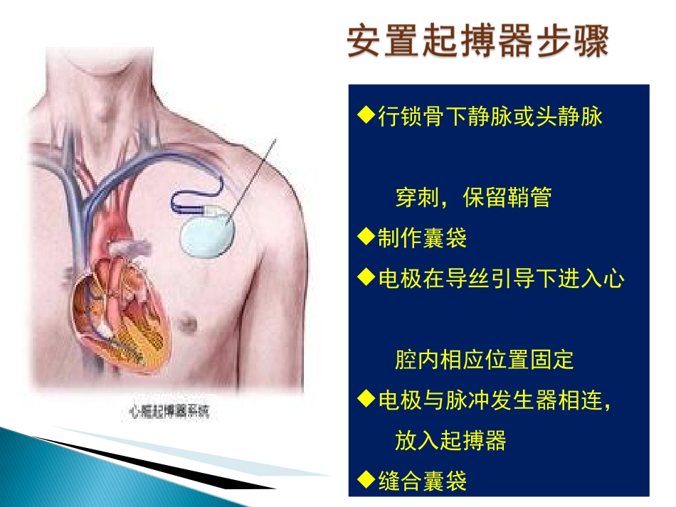 永久性人工起搏器植入术后囊袋并发症的预防和医疗护理讲义_第3页