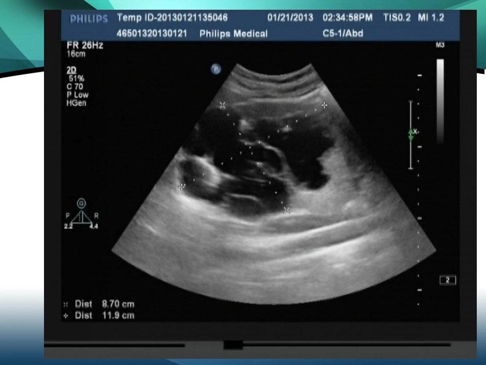 重复肾超声图片分解_第3页