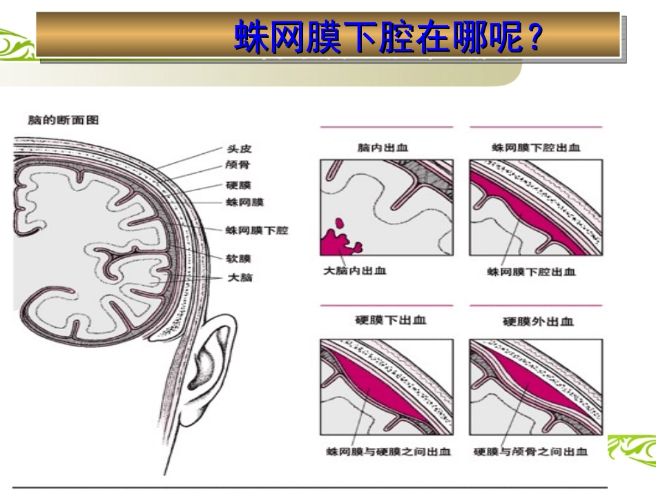 蛛网膜下腔出血课件_第3页